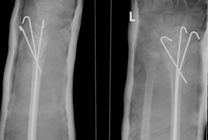 Distal Radius Growth Arrest K wire